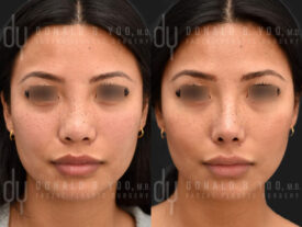 Asian Rhinoplasty with rib cartilage and diced cartilage fascia (DCF)