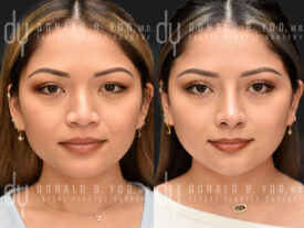 Asian Rhinoplasty with rib cartilage, diced cartilage fascia (DCF) and alarplasty