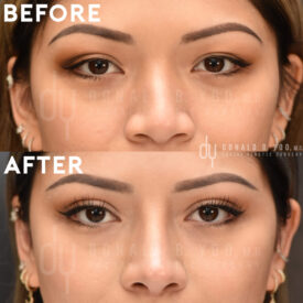 Upper blepharoplasty