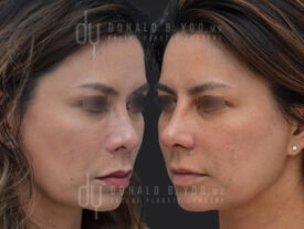 Asian Rhinoplasty with rib cartilage and diced cartilage fascia (DCF)