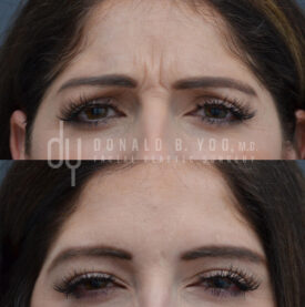 Botox for forehead and frown lines