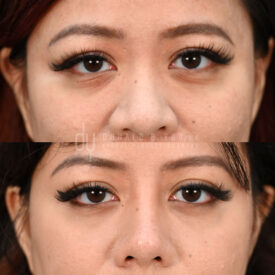 Endoscopic browlift