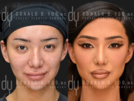 Revision Asian Rhinoplasty with rib cartilage