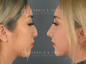 Asian Rhinoplasty with rib cartilage and diced cartilage fascia (DCF)