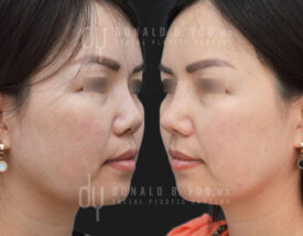 Revision Asian Rhinoplasty with rib cartilage, diced cartilage fascia (DCF) and implant removal