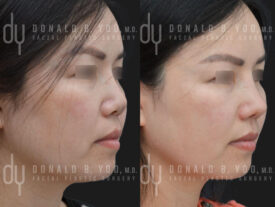 Revision rhinoplasty with rib cartilage, diced cartilage fascia (DCF) and silicone implant removal