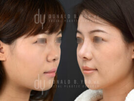 Asian Rhinoplasty with rib cartilage and diced cartilage fascia (DCF)