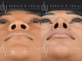African American rhinoplasty with rib cartilage, diced cartilage fascia (DCF) and alarplasty