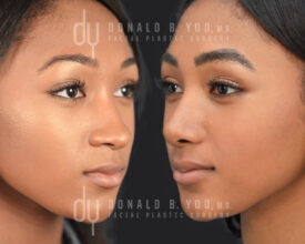 African American rhinoplasty with rib cartilage and diced cartilage fascia (DCF)