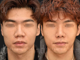 Male rhinoplasty with rib cartilage and diced cartilage fascia (DCF)