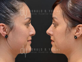 Primary rhinoplasty and septoplasty