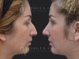 Primary rhinoplasty and septoplasty