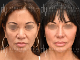 Asian Rhinoplasty with rib cartilage, diced cartilage fascia (DCF) and alarplasty
