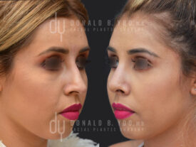 Primary rhinoplasty and septoplasty