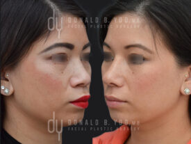 Asian Rhinoplasty with alar base modification