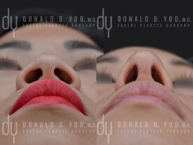 Asian rhinoplasty with rib cartilage, diced cartilage fascia (DCF) and alarplasty