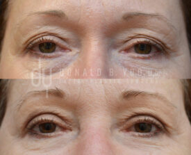 Upper blepharoplasty