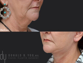Deep plane facelift