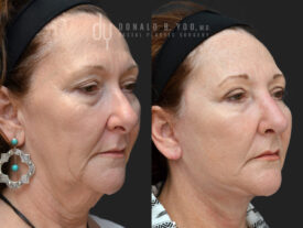 Deep plane facelift