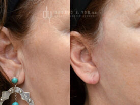 Deep plane facelift