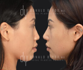 Asian Rhinoplasty with rib cartilage and diced cartilage fascia (DCF)