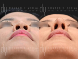 Asian rhinoplasty with rib cartilage, diced cartilage fascia (DCF) and alarplasty