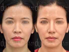 Asian Rhinoplasty with rib cartilage, diced cartilage fascia (DCF) and alarplasty