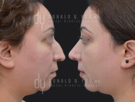 Primary rhinoplasty and septoplasty