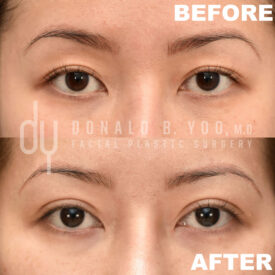 Upper blepharoplasty with Asian double eyelid creation