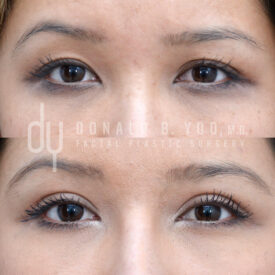 Upper blepharoplasty with Asian double eyelid creation