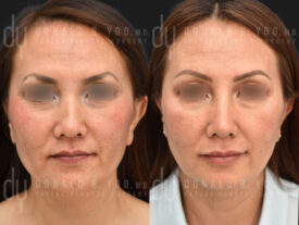 Asian Rhinoplasty with rib cartilage and diced cartilage fascia (DCF)