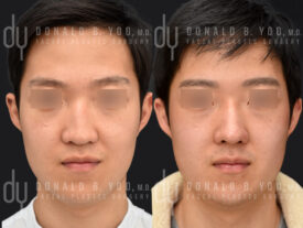 Male rhinoplasty with rib cartilage and diced cartilage fascia (DCF)