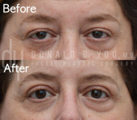 Upper blepharoplasty