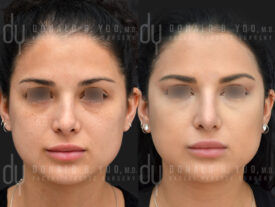 Revision rhinoplasty with rib cartilage