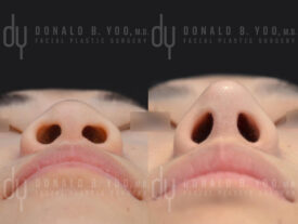 Asian rhinoplasty with rib cartilage, diced cartilage fascia (DCF) and alarplasty