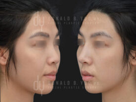Asian Rhinoplasty with rib cartilage, diced cartilage fascia (DCF) and alarplasty