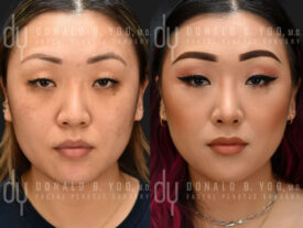 Revision rhinoplasty with rib cartilage, diced cartilage fascia (DCF) and silicone implant removal