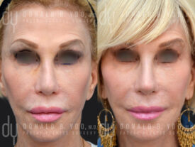 Revision rhinoplasty with rib cartilage and diced cartilage fascia (DCF)