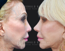 Revision rhinoplasty with rib cartilage