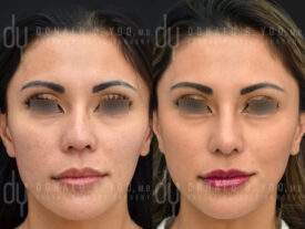 Revision rhinoplasty with rib cartilage, diced cartilage fascia (DCF) and silicone implant removal