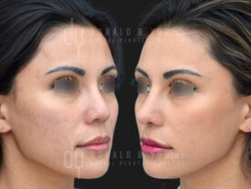Revision Asian Rhinoplasty with rib cartilage and diced cartilage fascia (DCF)