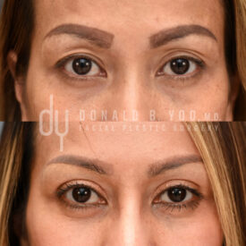 Upper blepharoplasty