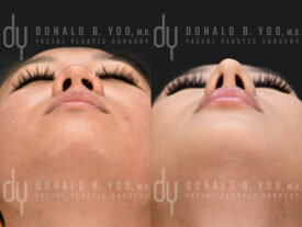 Asian rhinoplasty with rib cartilage, diced cartilage fascia (DCF) and alarplasty