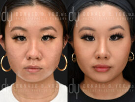 Asian Rhinoplasty with alar base modification