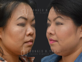 Asian Rhinoplasty with rib cartilage and diced cartilage fascia (DCF)
