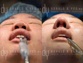 Asian rhinoplasty with rib cartilage, diced cartilage fascia (DCF) and alarplasty