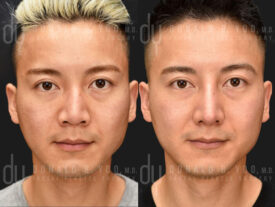 Male rhinoplasty with rib cartilage and diced cartilage fascia (DCF)