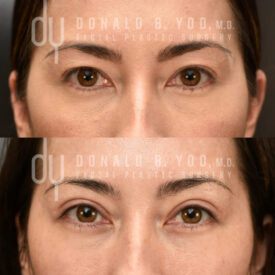 Upper blepharoplasty
