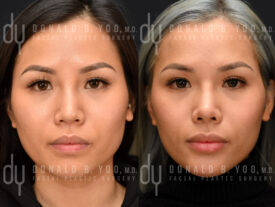 Asian Rhinoplasty with rib cartilage and diced cartilage fascia (DCF)