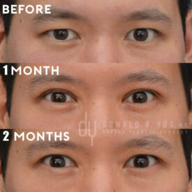 Upper blepharoplasty with Asian double eyelid creation
